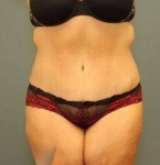 ABDOMINOPLASTY WITH LIPOSUCTION : Case 83 After